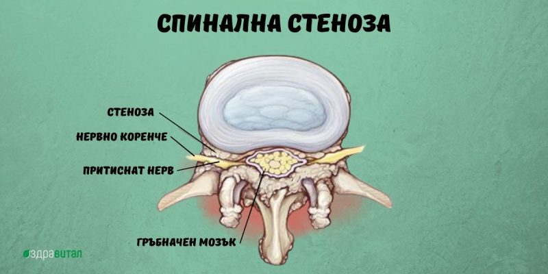 spinal-stenosis